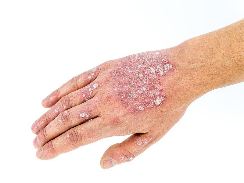 Psoriasis