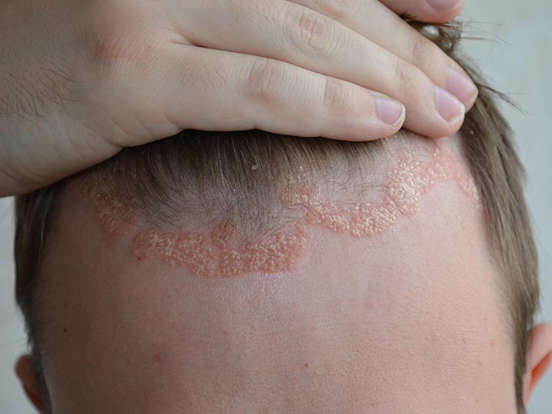 Psoriasis-Large-2.jpg