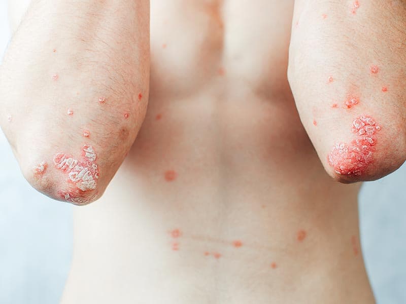 Psoriasis-Large-3.jpg