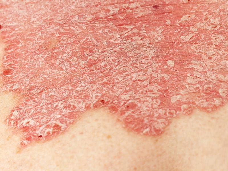 Psoriasis-Large-4.jpg