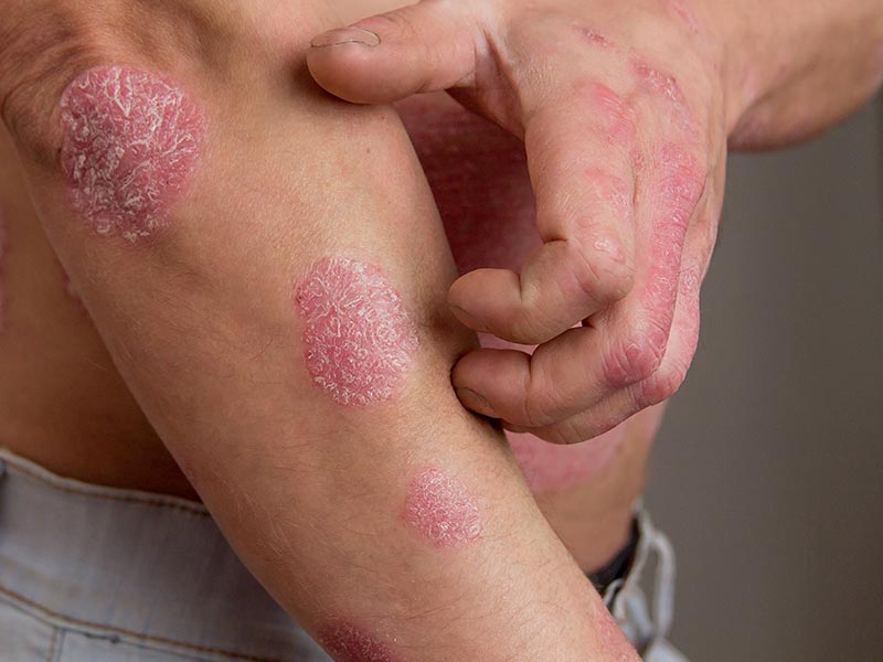 Psoriasis-Large-5.jpg