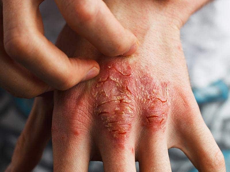 Psoriasis-Large-7.jpg