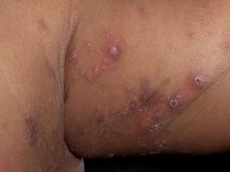 Scabies-Large-2.jpg