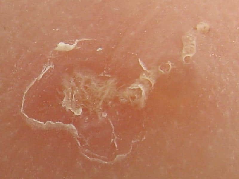 Scabies-Large-4.jpg