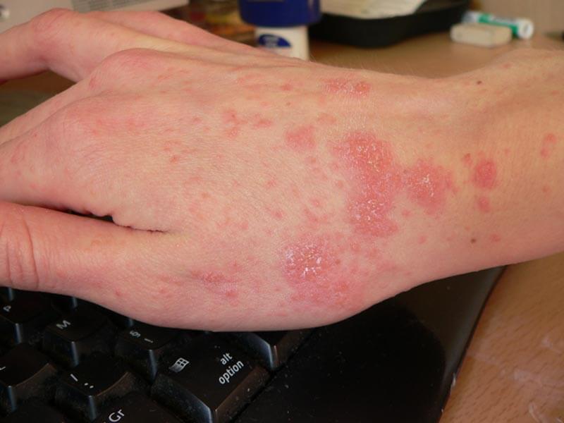 Scabies-Large-7.jpg
