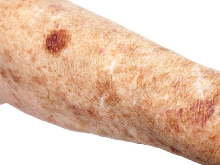 Solar-lentigo-Large-1.jpg