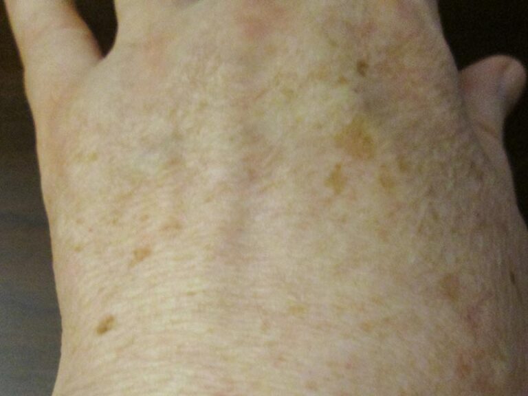 Solar-lentigo-Large-2.jpg