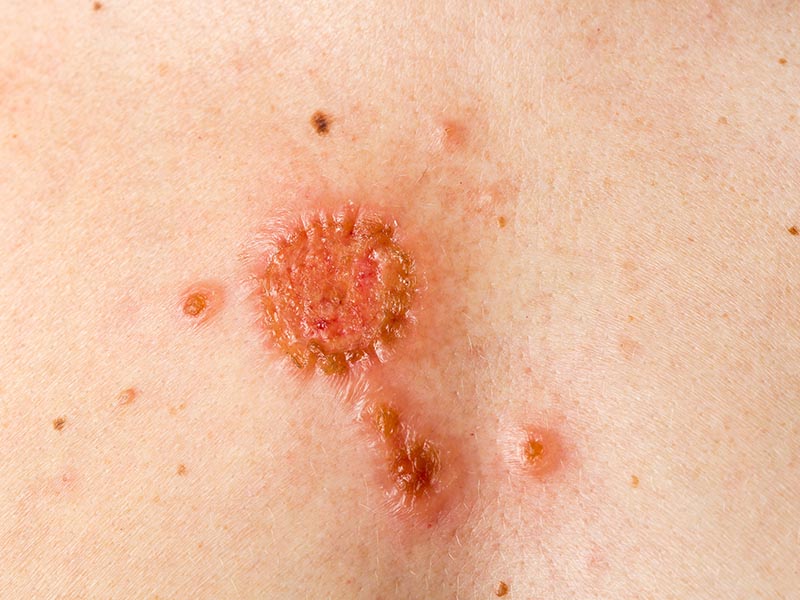 Squamous-Carcinoma-Large-2.jpg