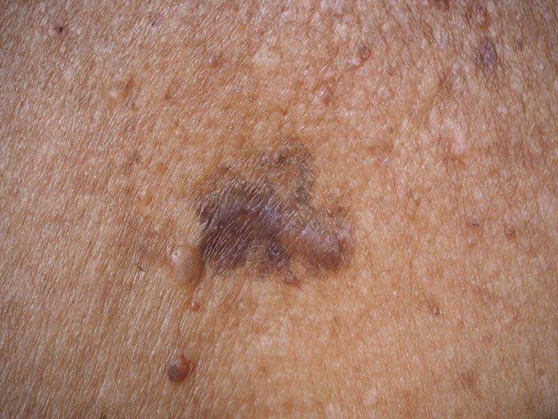 Squamous-Carcinoma-Large-3.jpg