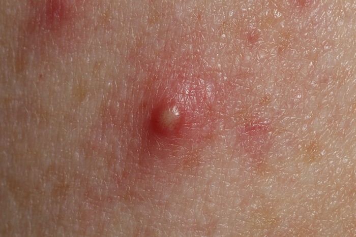 acne-spot-large.jpg