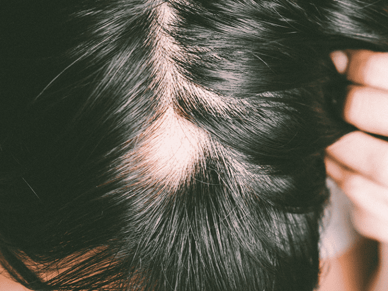 alopecia_0000_AdobeStock_212957221.png