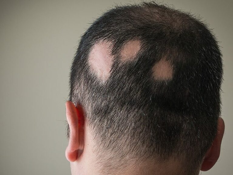 alopecia_0003_AdobeStock_133590978-1.jpg