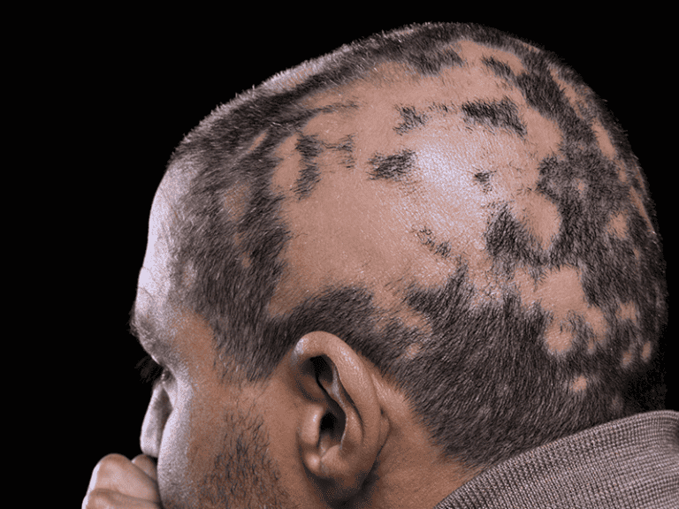 alopecia_0005_AdobeStock_75945057.png