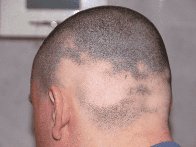 alopecia_0006_AdobeStock_4167055.png