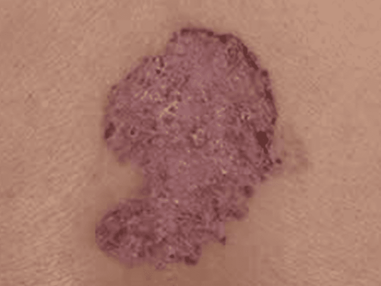 basalcellcarcinoma_0004_Basal-Cell-Carcinoma-2.png