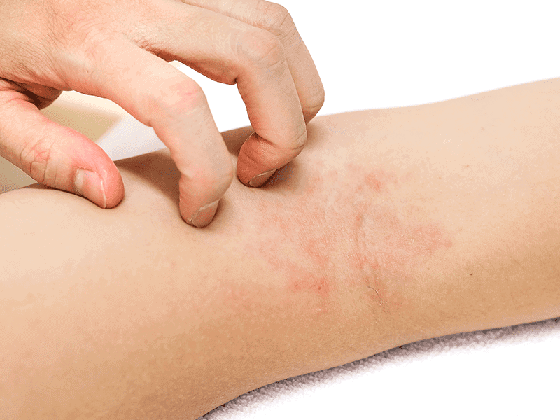 eczema_0001_AdobeStock_176541850.png