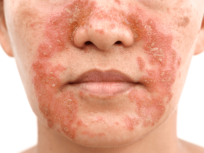 eczema_0003_AdobeStock_195864178.png