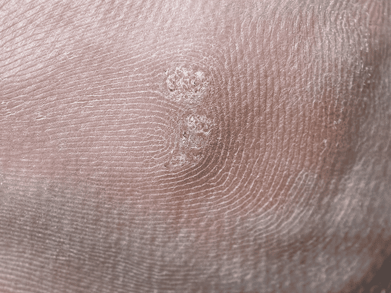 wartsandverrucas_0000_AdobeStock_262601665.png