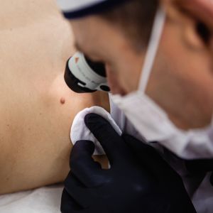 getting moles checked