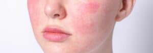 Rosacea awareness month